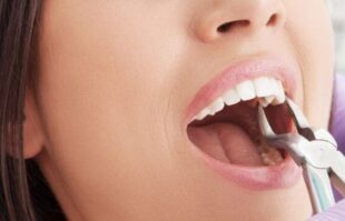 Diş Çekim Fiyatları 2023, Diş Çekim Ücreti Güncel Fiyat img